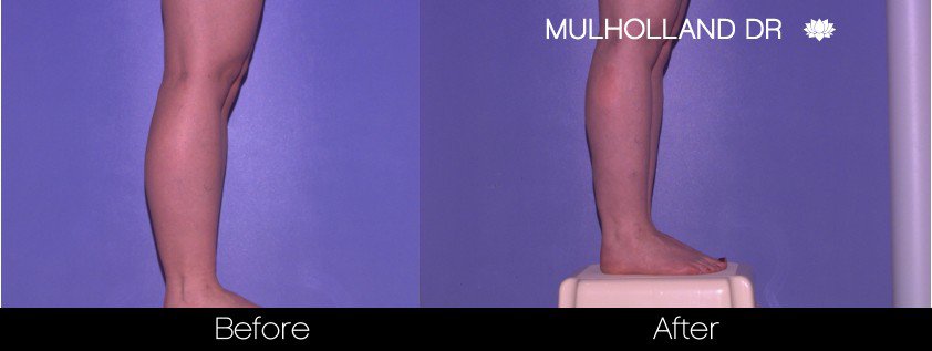 BodyTite Liposuction - Before and After Gallery - Patient Photo 87