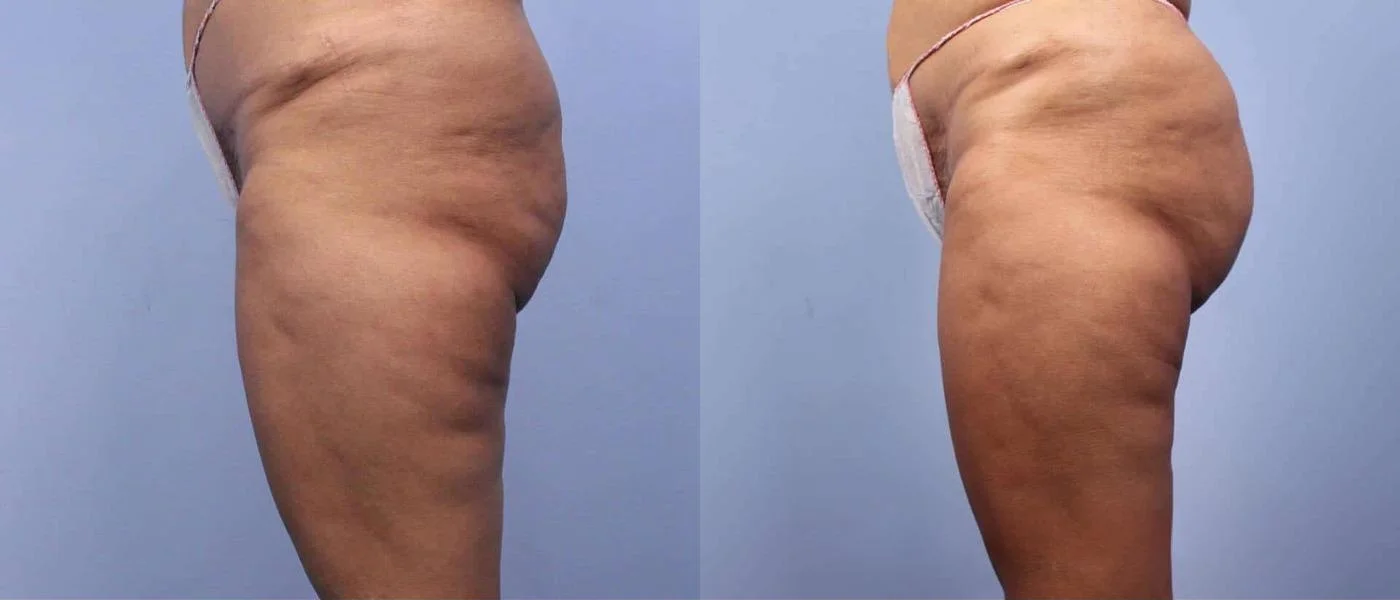 Brazilian Butt Lift -Before and After Gallery - Patient Photo 1