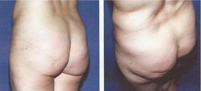 Brazilian Butt Lift -Before and After Gallery - Patient Photo 10