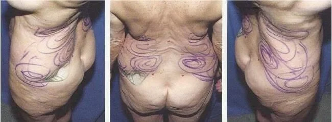 Brazilian Butt Lift -Before and After Gallery - Patient Photo 11