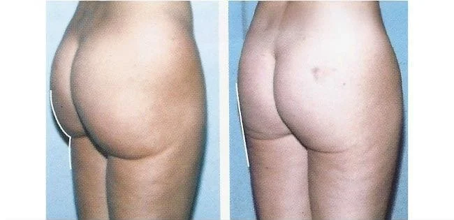 Brazilian Butt Lift -Before and After Gallery - Patient Photo 12