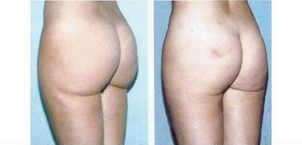 Brazilian Butt Lift -Before and After Gallery - Patient Photo 14