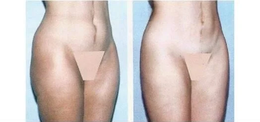 Brazilian Butt Lift -Before and After Gallery - Patient Photo 15