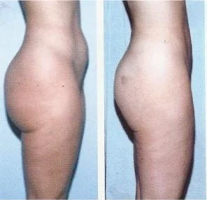 Brazilian Butt Lift -Before and After Gallery - Patient Photo 16