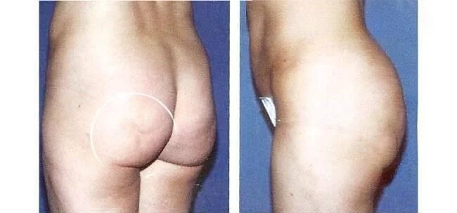 Brazilian Butt Lift -Before and After Gallery - Patient Photo 17