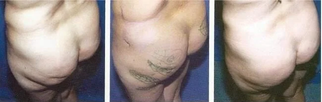 Brazilian Butt Lift -Before and After Gallery - Patient Photo 18