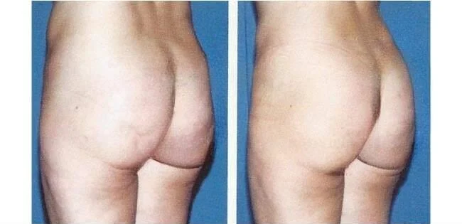 Brazilian Butt Lift -Before and After Gallery - Patient Photo 19