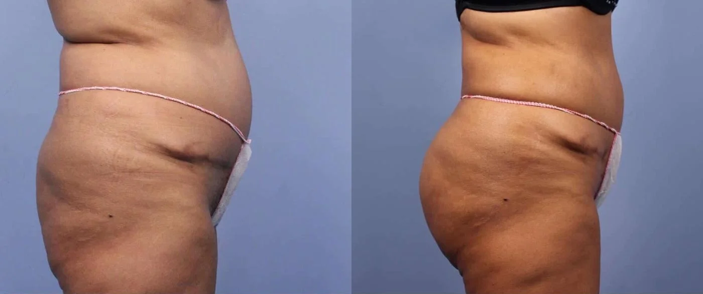 Brazilian Butt Lift -Before and After Gallery - Patient Photo 2