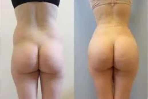 Brazilian Butt Lift -Before and After Gallery - Patient Photo 20