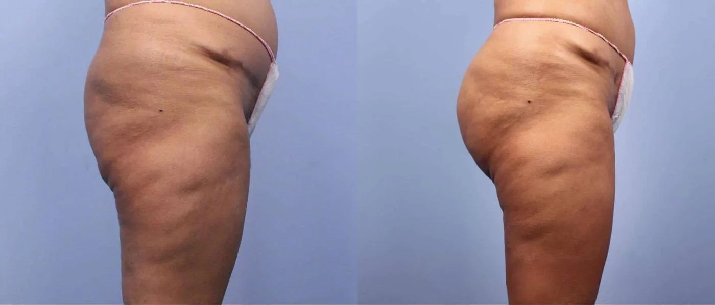 Brazilian Butt Lift -Before and After Gallery - Patient Photo 3