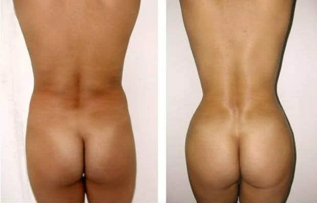 Brazilian Butt Lift -Before and After Gallery - Patient Photo 4
