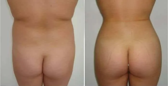 Before and after comparison images of a Brazilian Butt Lift procedure targeting hip dips.