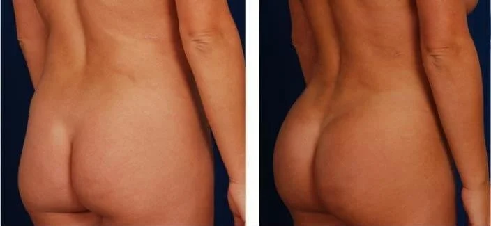 Brazilian Butt Lift -Before and After Gallery - Patient Photo 6