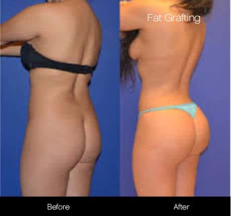 Brazilian Butt Lift -Before and After Gallery - Patient Photo 7