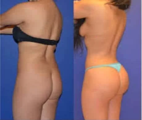 Brazilian Butt Lift -Before and After Gallery - Patient Photo 7