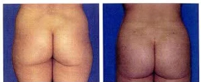 Brazilian Butt Lift -Before and After Gallery - Patient Photo 9