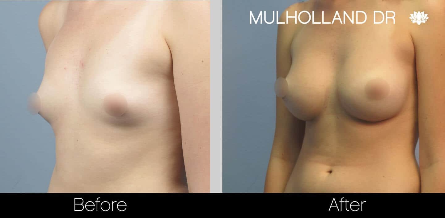 Breast Augmentation - Before and After Gallery - Patient Photo 23