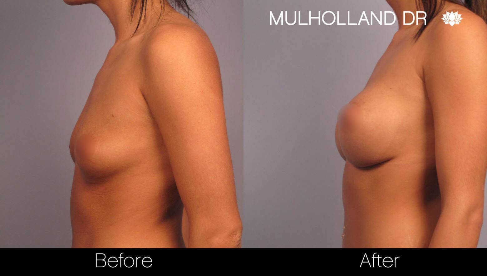 Breast Augmentation - Before and After Gallery - Patient Photo 3