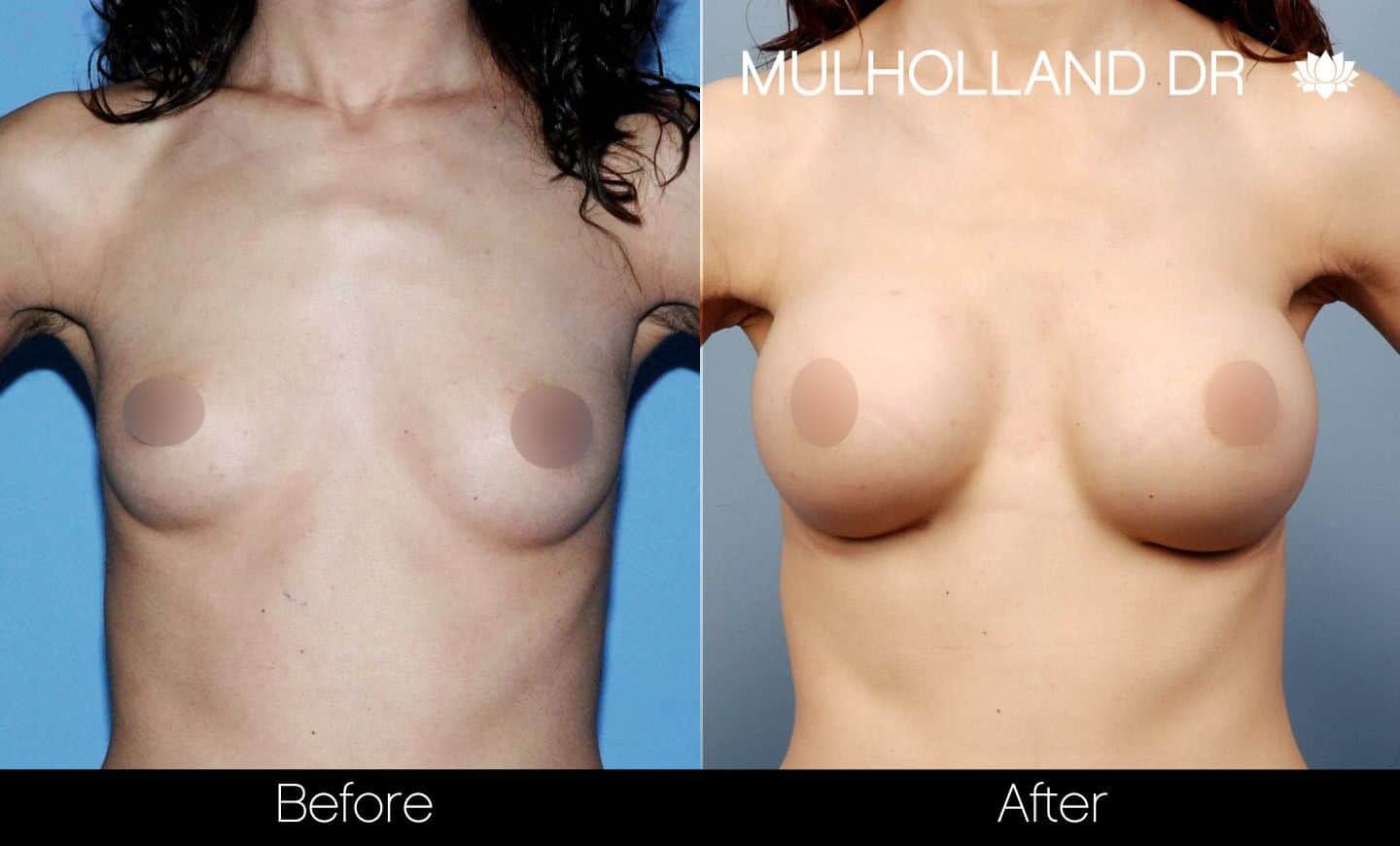 Breast Augmentation - Before and After Gallery - Patient Photo 33