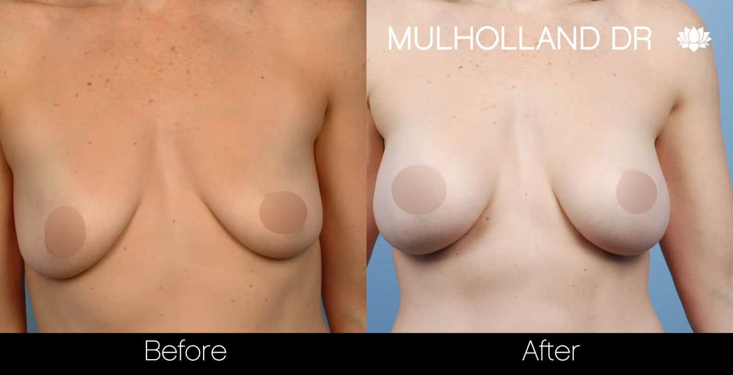 Breast Augmentation - Before and After Gallery - Patient Photo 36