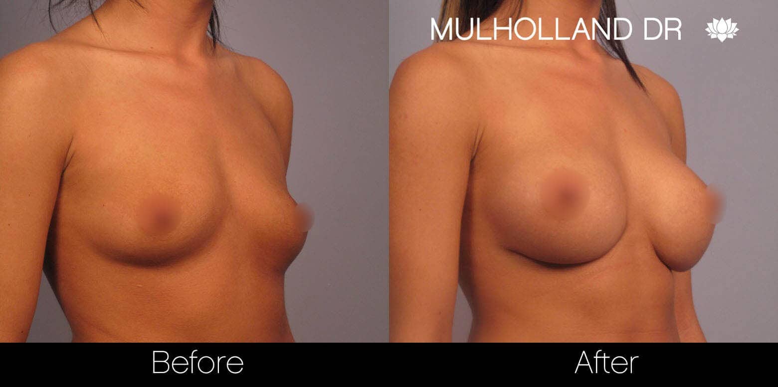 Breast Augmentation - Before and After Gallery - Patient Photo 4