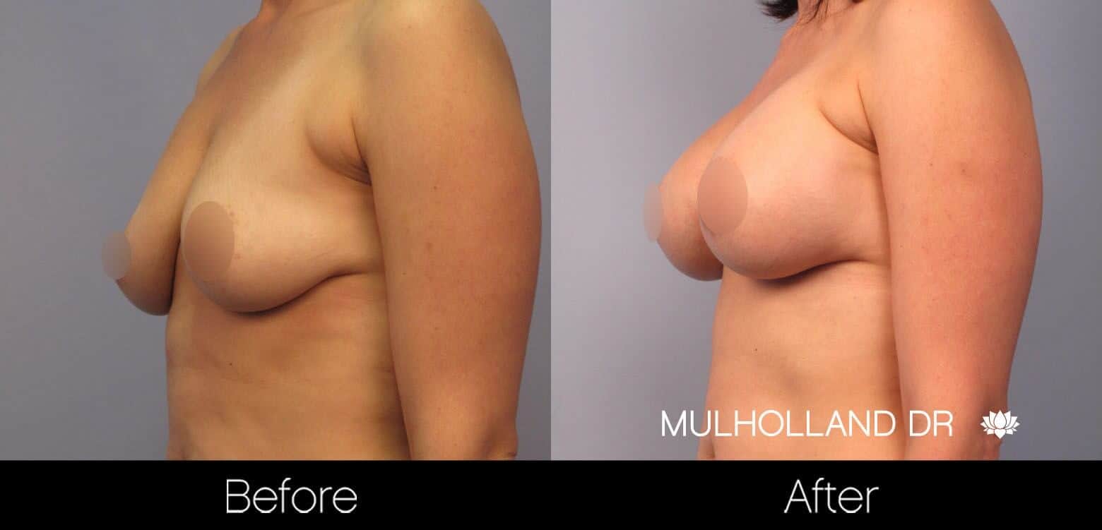 Breast Augmentation - Before and After Gallery - Patient Photo 47