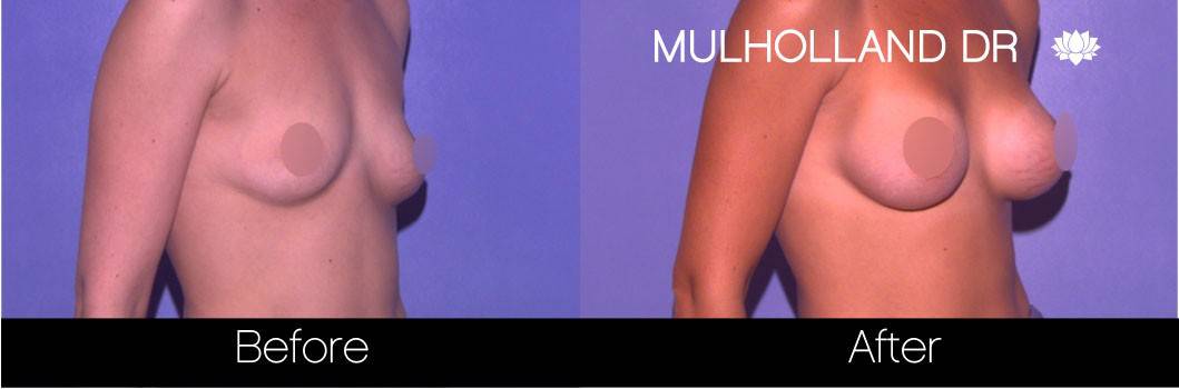 Breast Augmentation - Before and After Gallery - Patient Photo 63