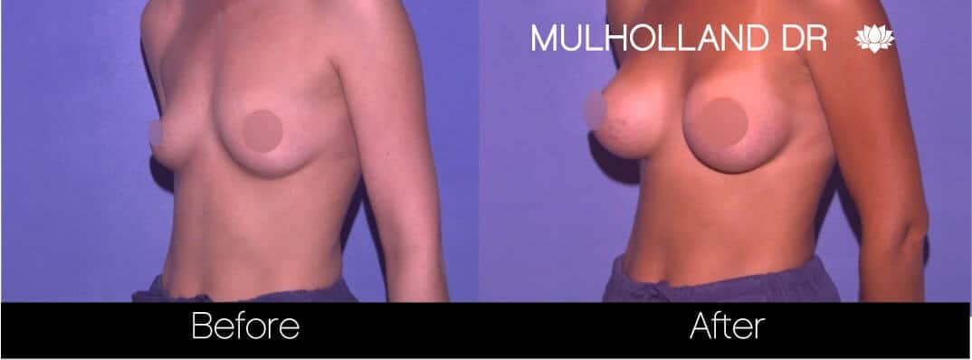 Breast Augmentation - Before and After Gallery - Patient Photo 65