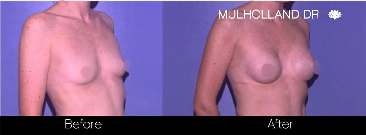 Breast Augmentation - Before and After Gallery - Patient Photo 77