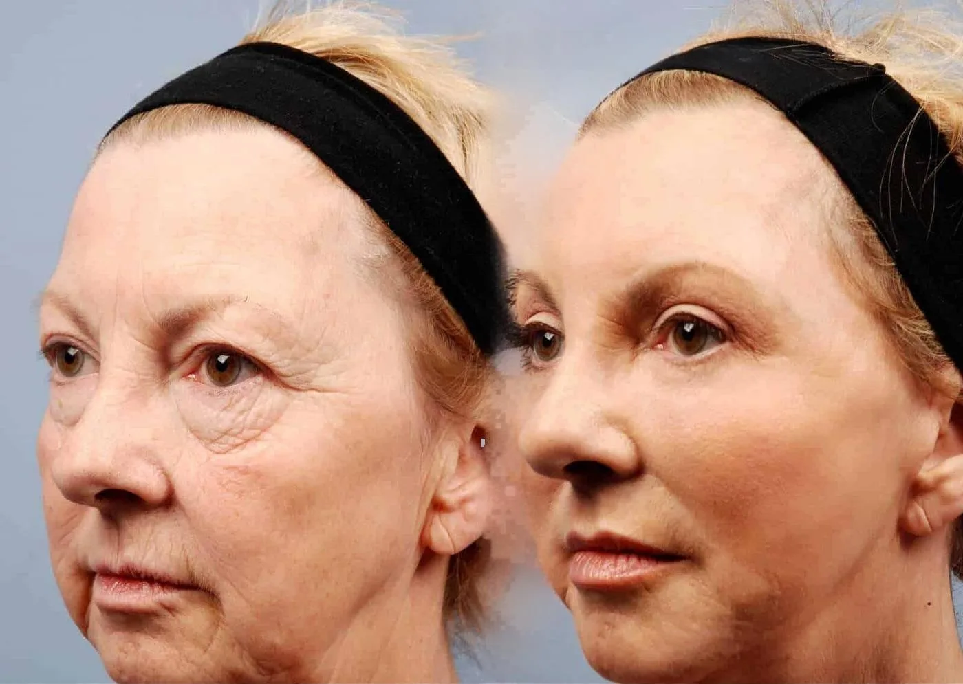 Brow Lift - Before and After Gallery - Patient Photo 12