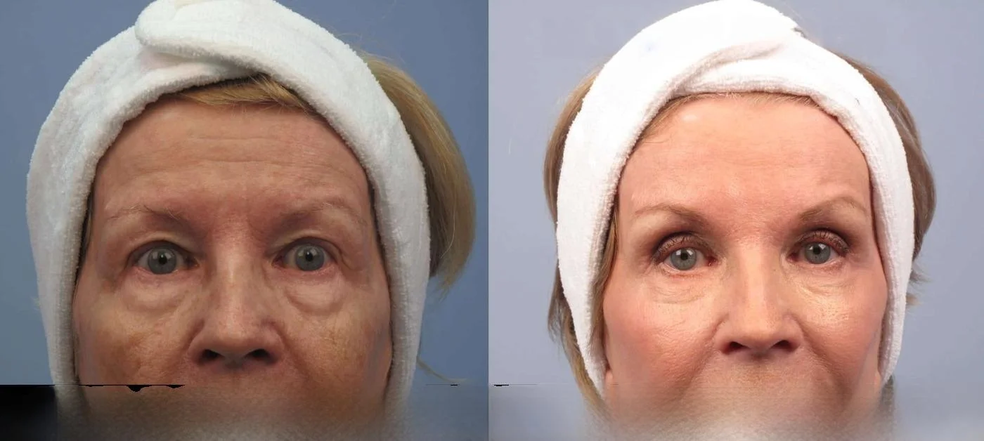Brow Lift - Before and After Gallery - Patient Photo 29