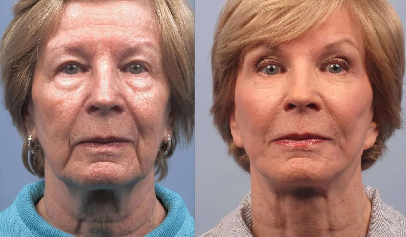 Brow Lift - Before and After Gallery - Patient Photo 30