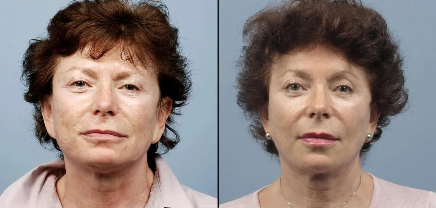 Brow Lift - Before and After Gallery - Patient Photo 40- Before and After Gallery - Patient Photo 41