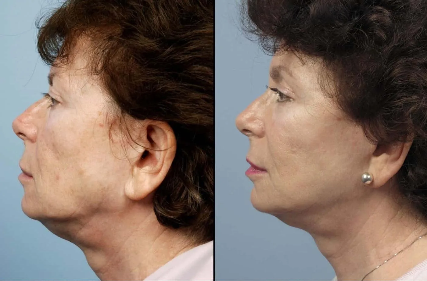 Brow Lift - Before and After Gallery - Patient Photo 40 - Before and After Gallery - Patient Photo 42