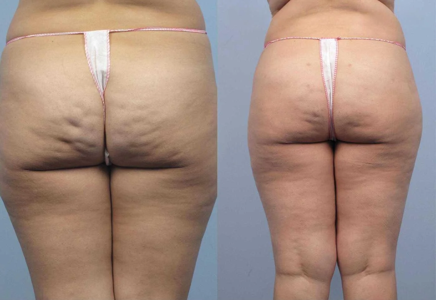 tirzepatide cellulite Cellulaze: Cellulite Removal