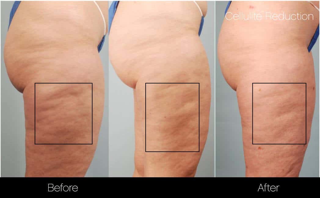 Cellutite -Before and After Gallery - Patient Photo 10