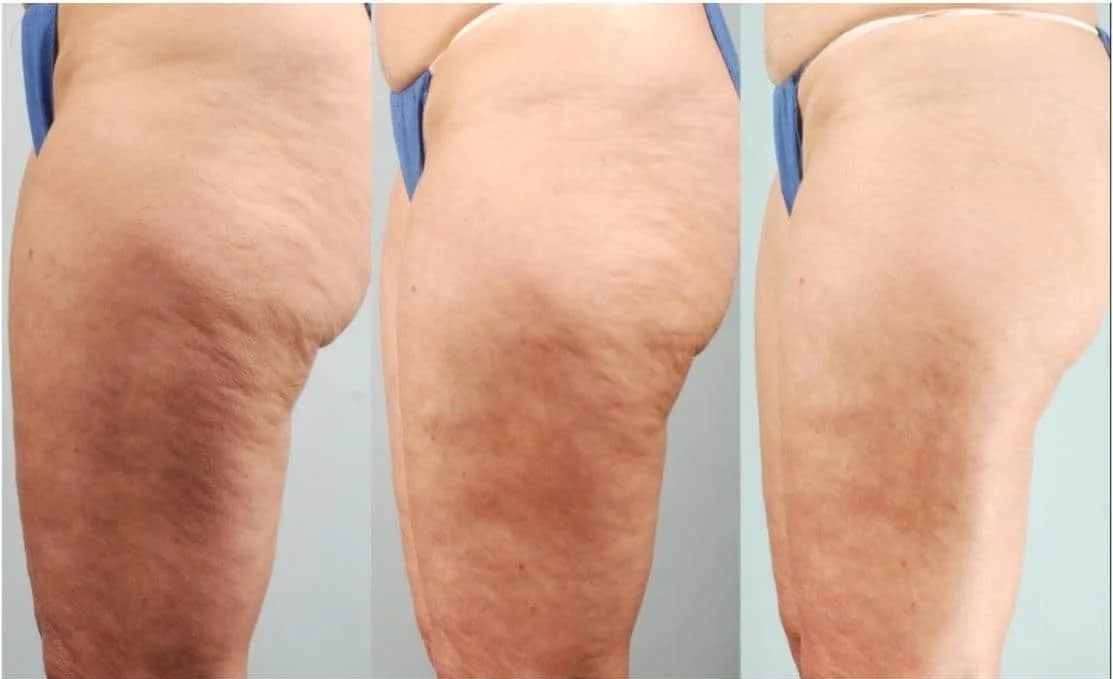 how to give b12 injection at home B12 Shots at Home: How, Where & How Often to Inject Yourself