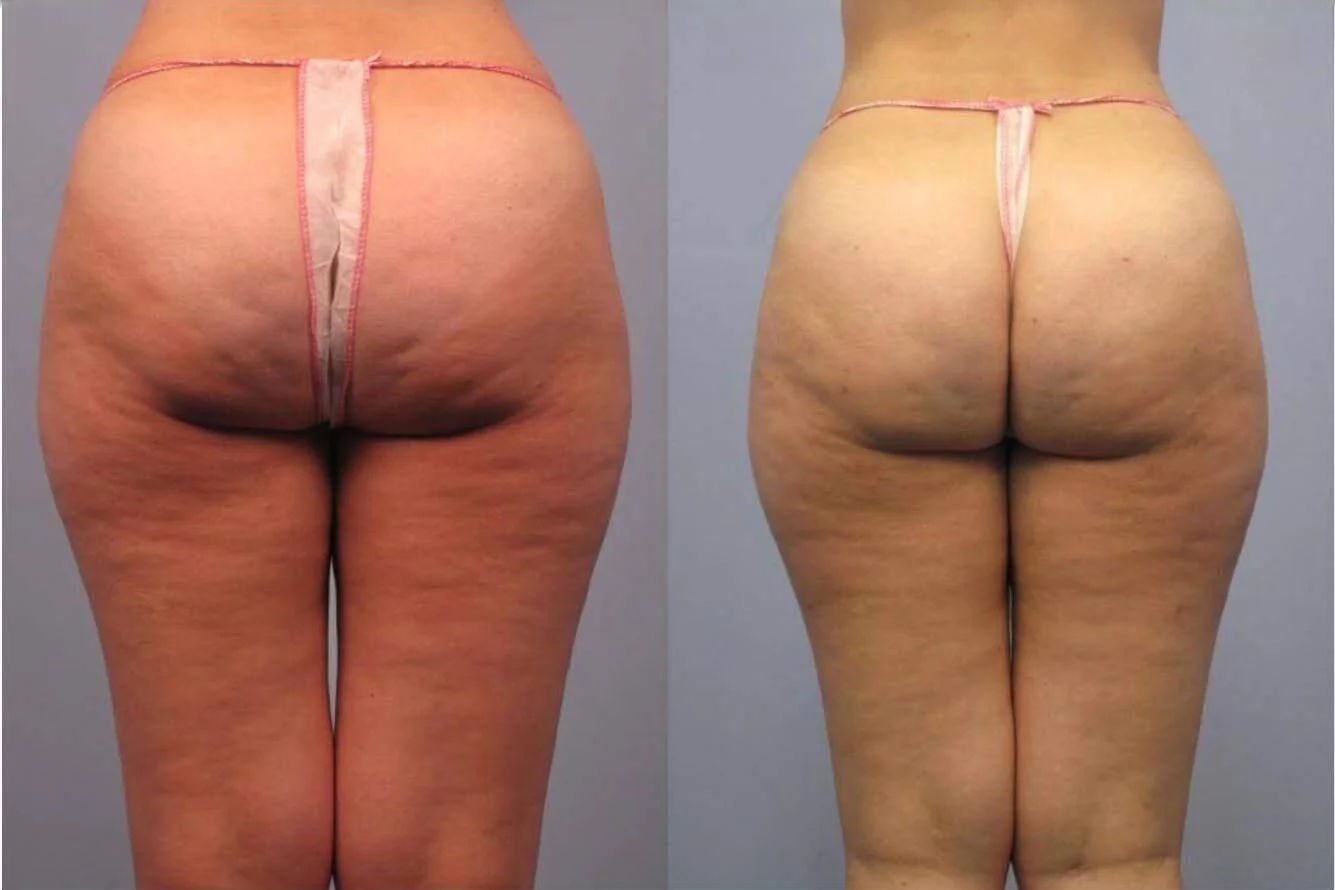 b12 b6 injections weight loss The Role of B12 Lipotropic Injections in Women's Weight Loss | Obstetrics & Gynecology & Women's Hormone Specialists in Mobile, AL