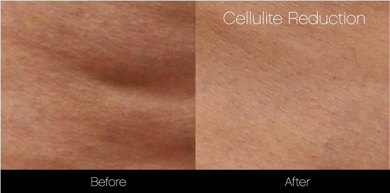 Cellutite -Before and After Gallery - Patient Photo 22