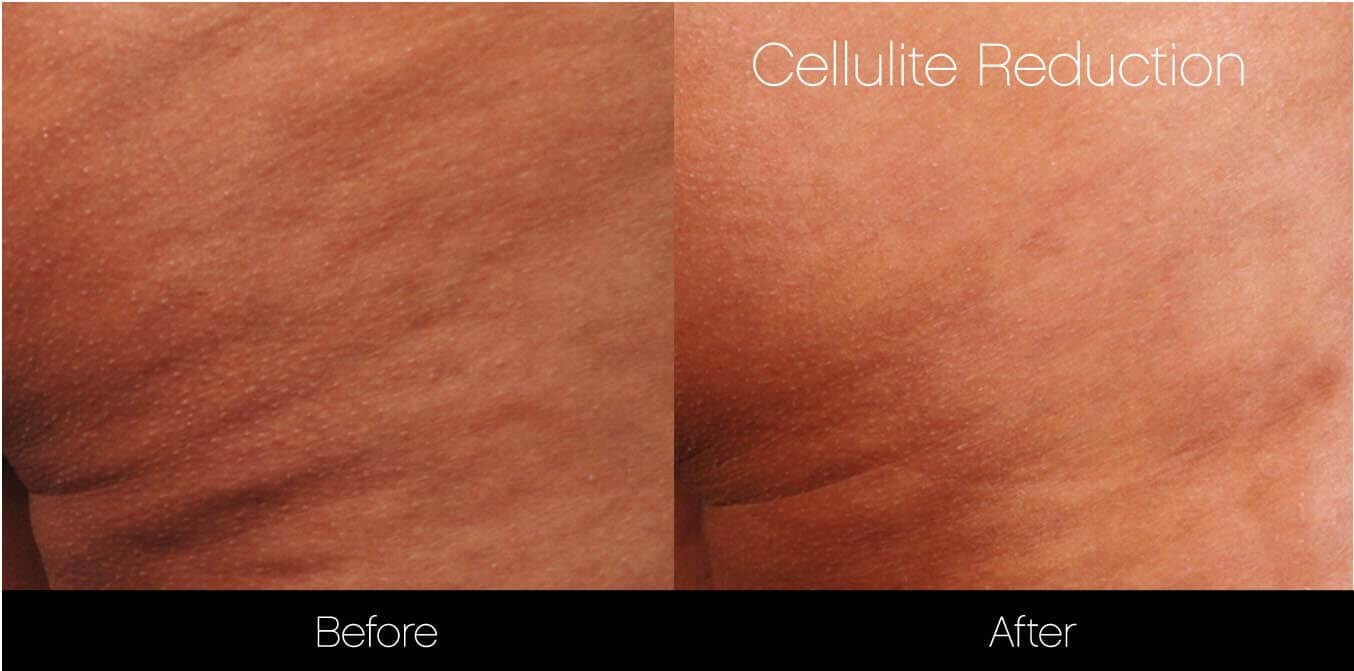 Cellutite -Before and After Gallery - Patient Photo 25