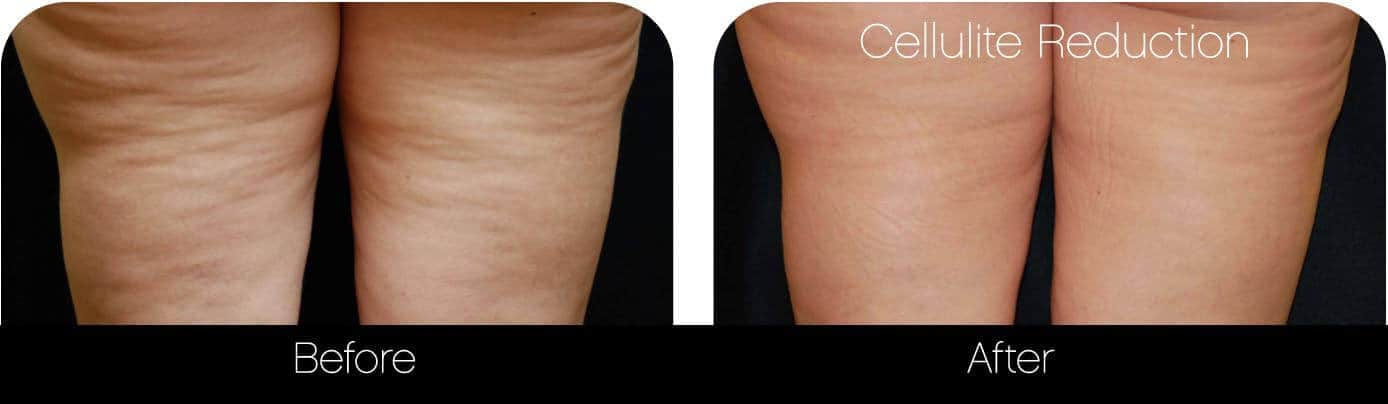 Cellutite -Before and After Gallery - Patient Photo 29