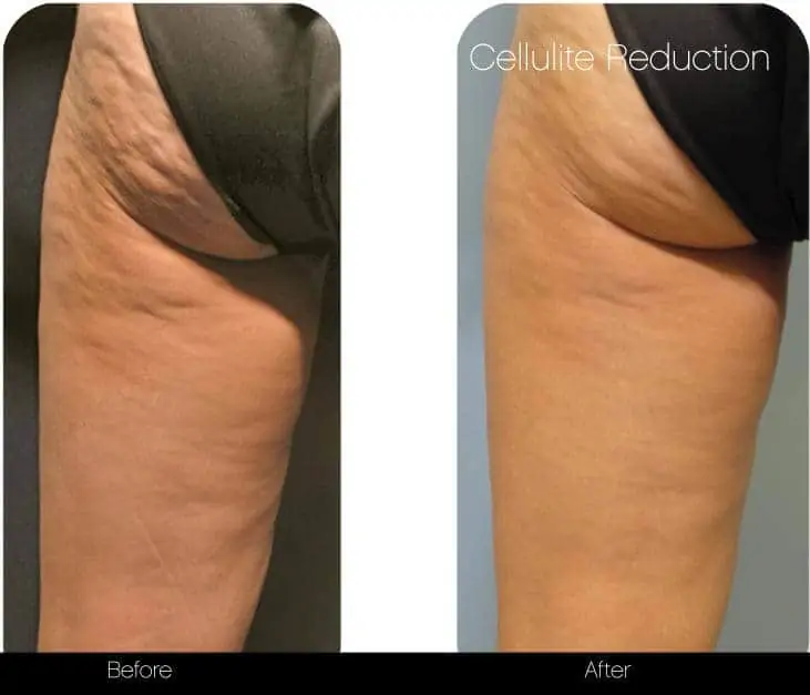tirzepatide cellulite Cellulaze: Cellulite Removal