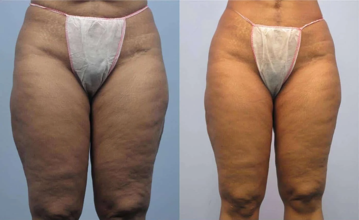 Cellulaze: Cellulite Removal | No Longer Offered at TPS