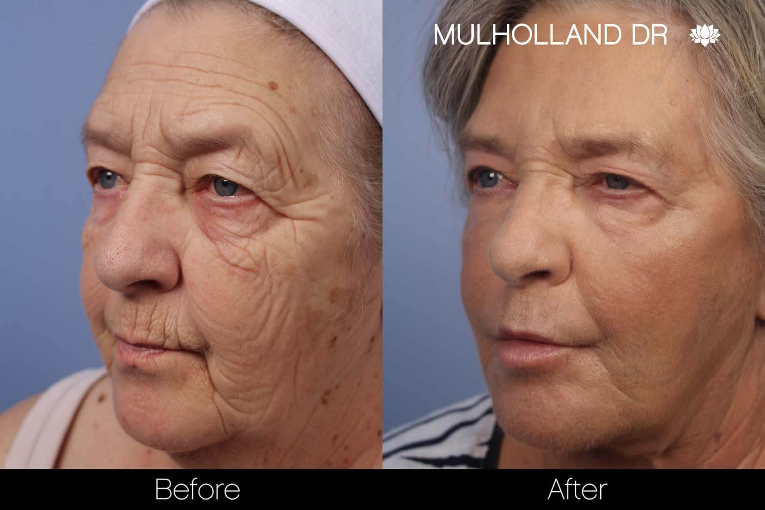 Cheek Lift - Before and After Gallery - Patient Photo 28