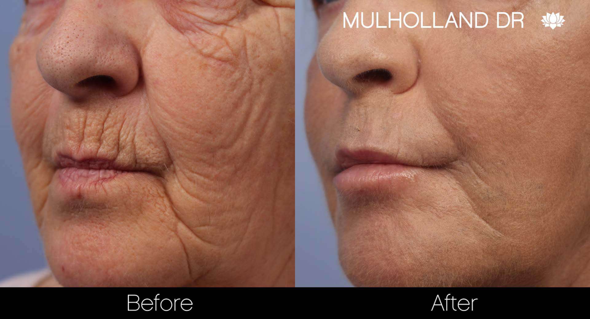 Cheek Lift - Before and After Gallery - Patient Photo 39