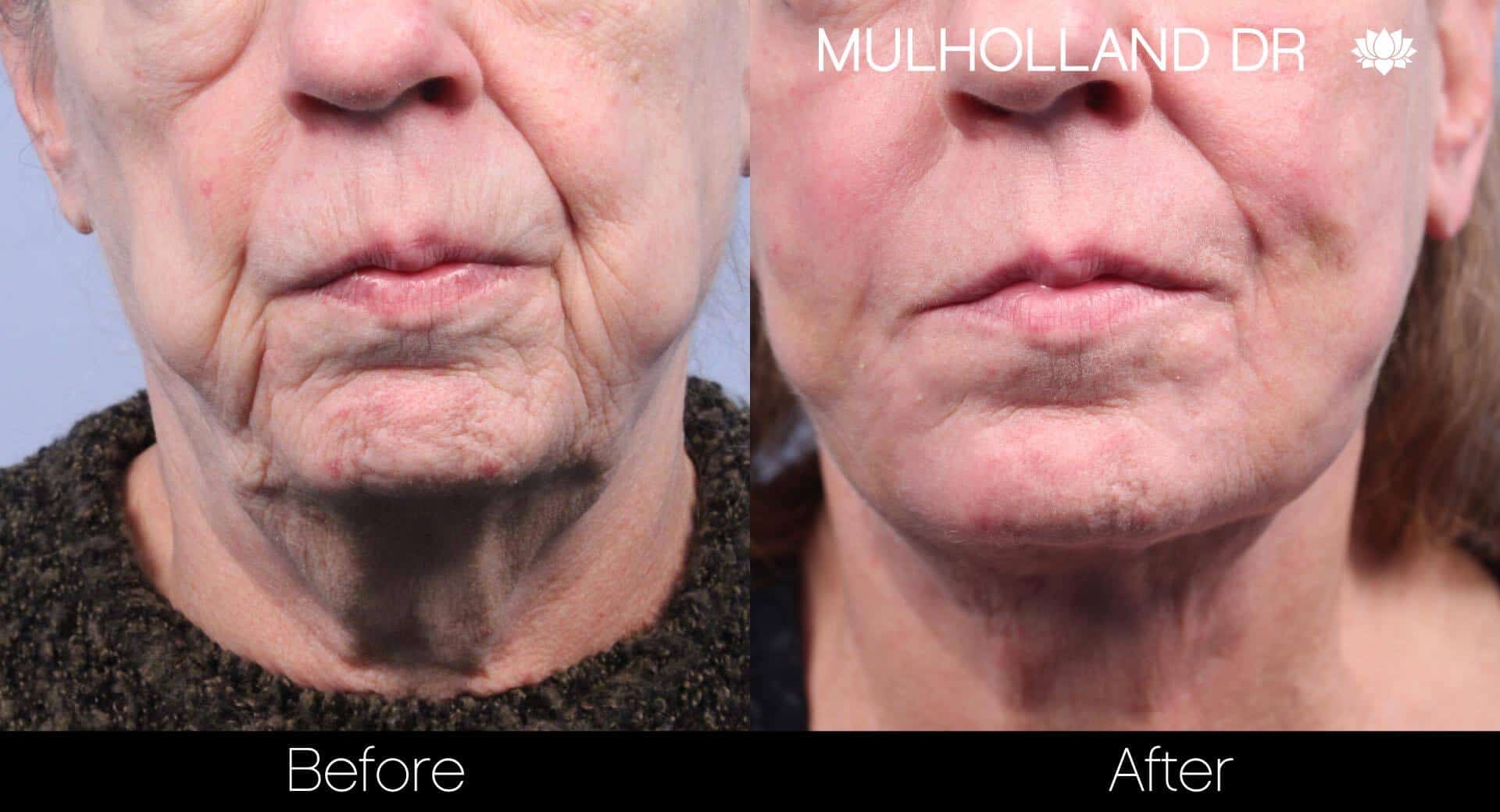 Cheek Lift - Before and After Gallery - Patient Photo 60