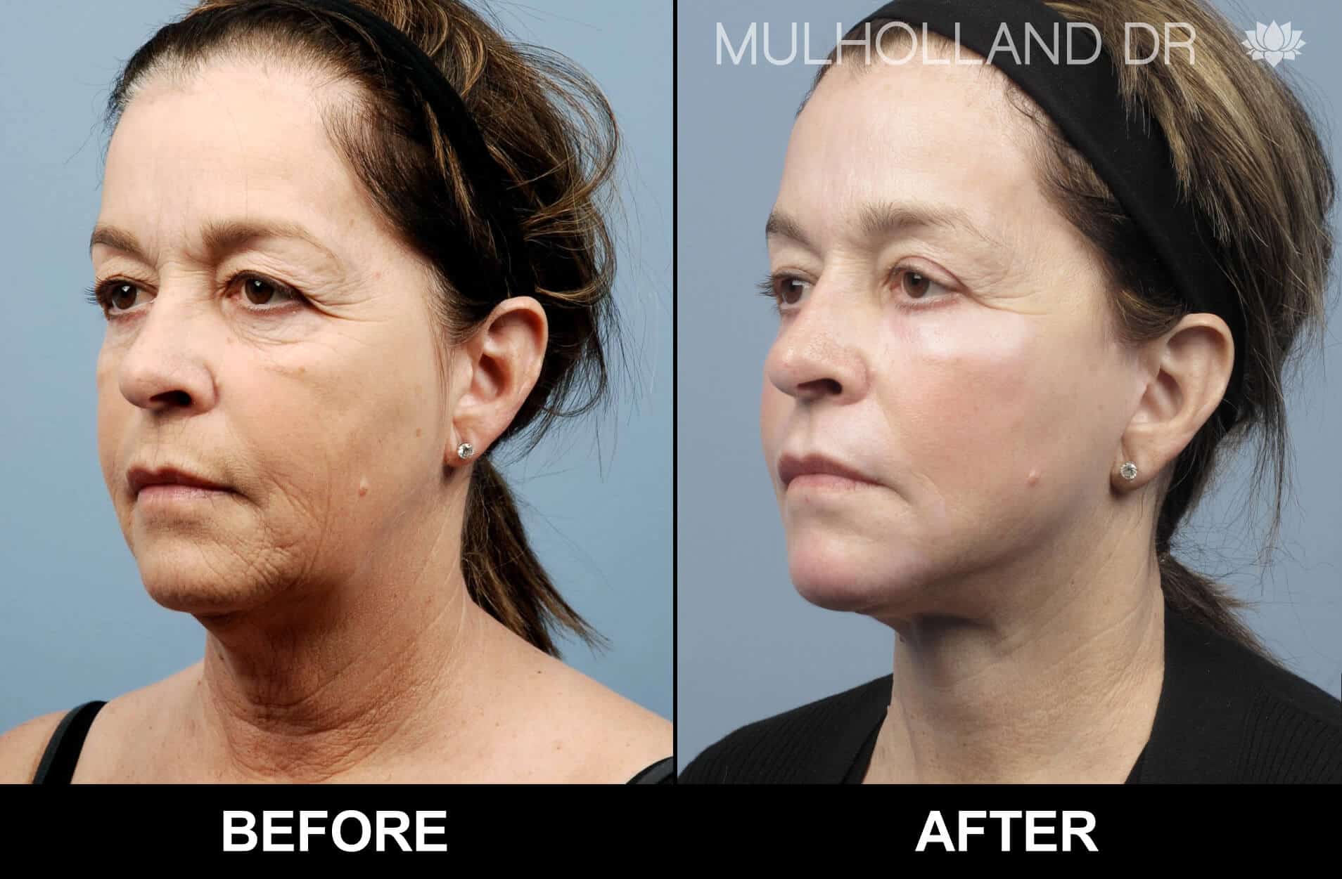 Cheek Lift - Before and After Gallery - Patient Photo 75