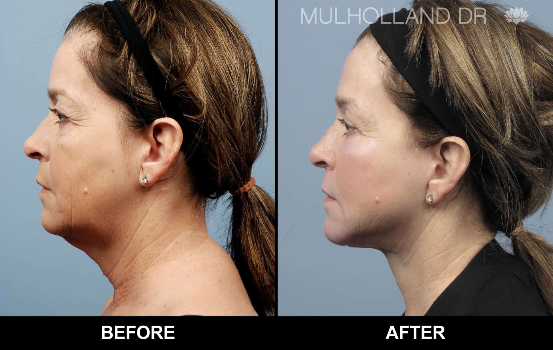 Cheek Lift - Before and After Gallery - Patient Photo 78