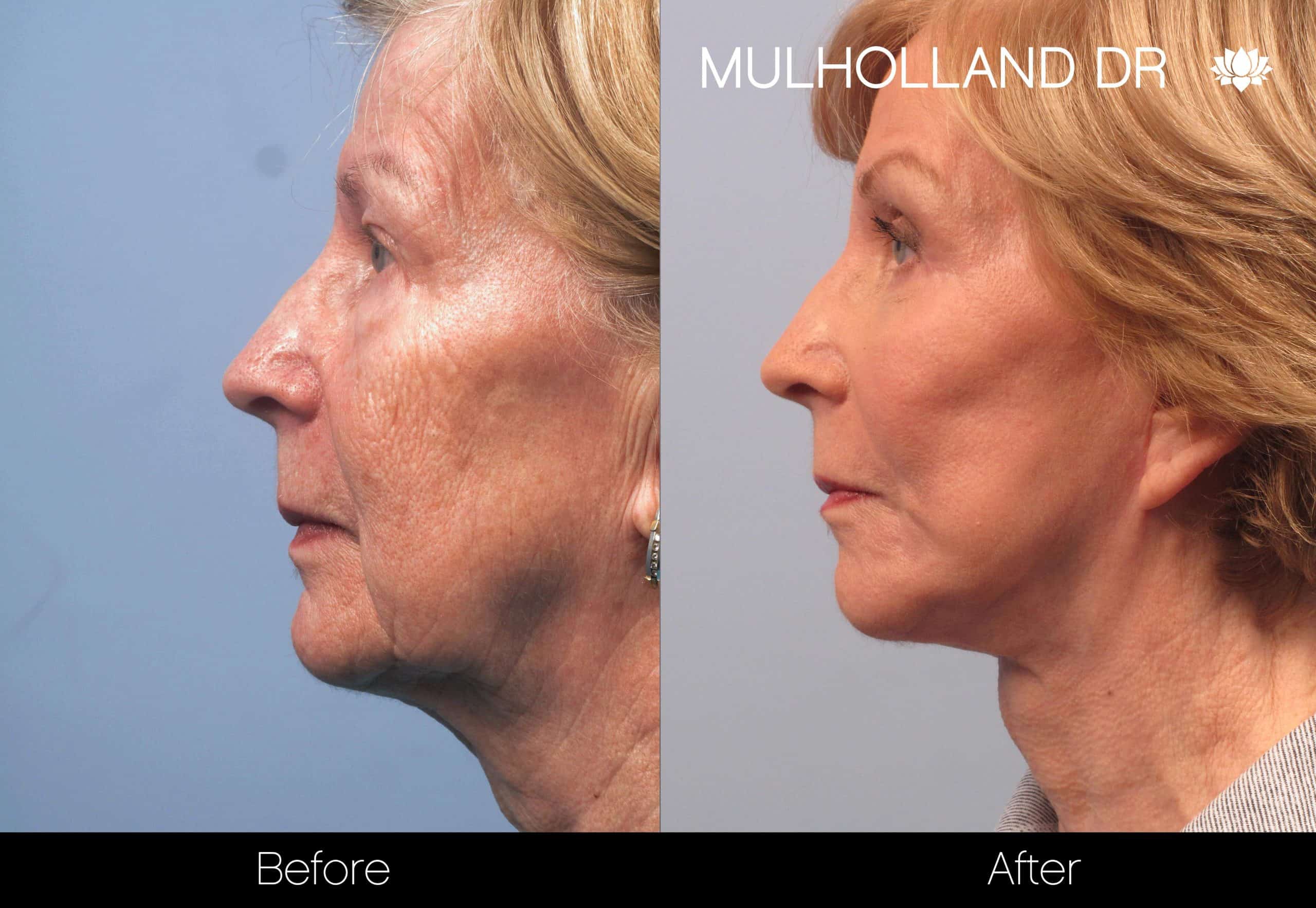 Cheek Lift - Before and After Gallery - Patient Photo 95