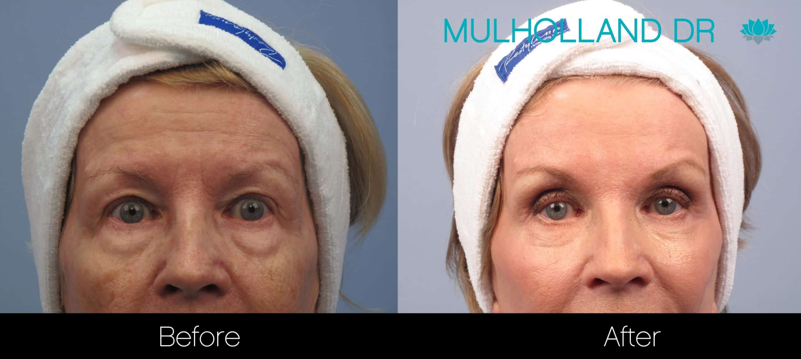 Cheek Lift - Before and After Gallery - Patient Photo 97